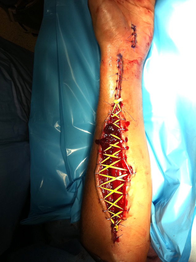 Forearm Fasciotomy Closure